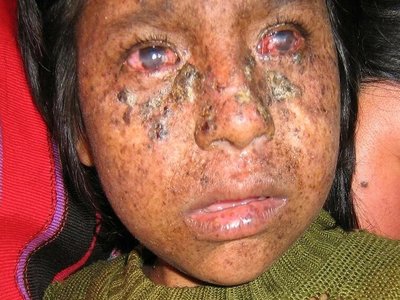 Xeroderma